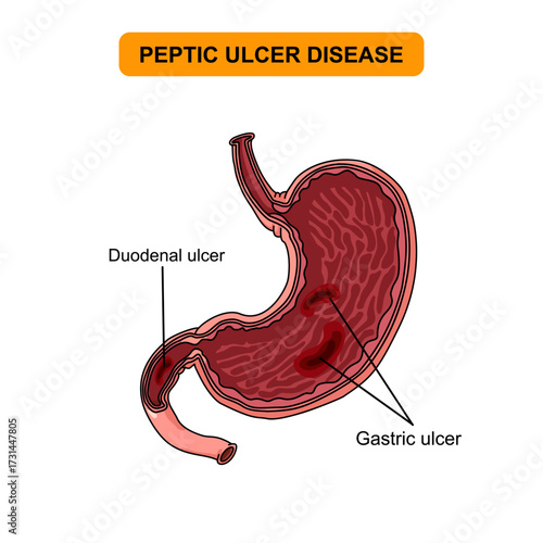 Illustration of peptic ulcer disease. Injuries to the inner lining of the stomach. Abdominal pain in the human body. Duodenal and gastric, vector illustration for medical, clinical, or educational.