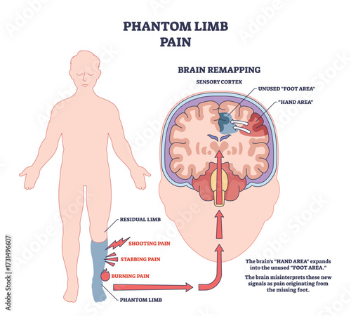 Phantom limb pain is shown with a human figure, brain diagram, and pain signals to illustrate brain remapping after limb loss. Outline diagram