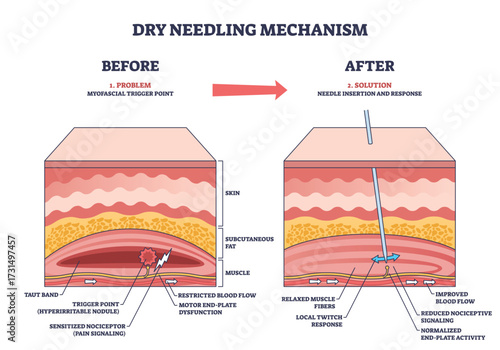 Dry needling mechanism shows needle insertion into muscle trigger point, illustrating blood flow and muscle response. Outline diagram
