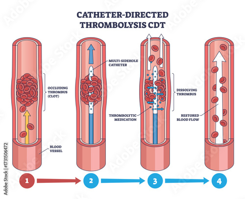 Catheter-Directed Thrombolysis CDT shows a catheter delivering medication to dissolve a blood clot in a vessel, restoring blood flow. Diagram