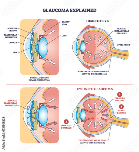 Glaucoma diagram shows impaired drainage, pressure buildup, and optic nerve damage in the eye. Key objects, optic nerve, trabecular meshwork, aqueous humor. Outline diagram