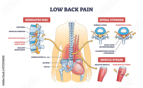 Low back pain diagram shows spine, herniated disc, spinal stenosis, and muscle strain with labeled anatomical structures. Outline diagram