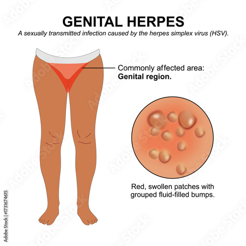 Genital herpes dark skin