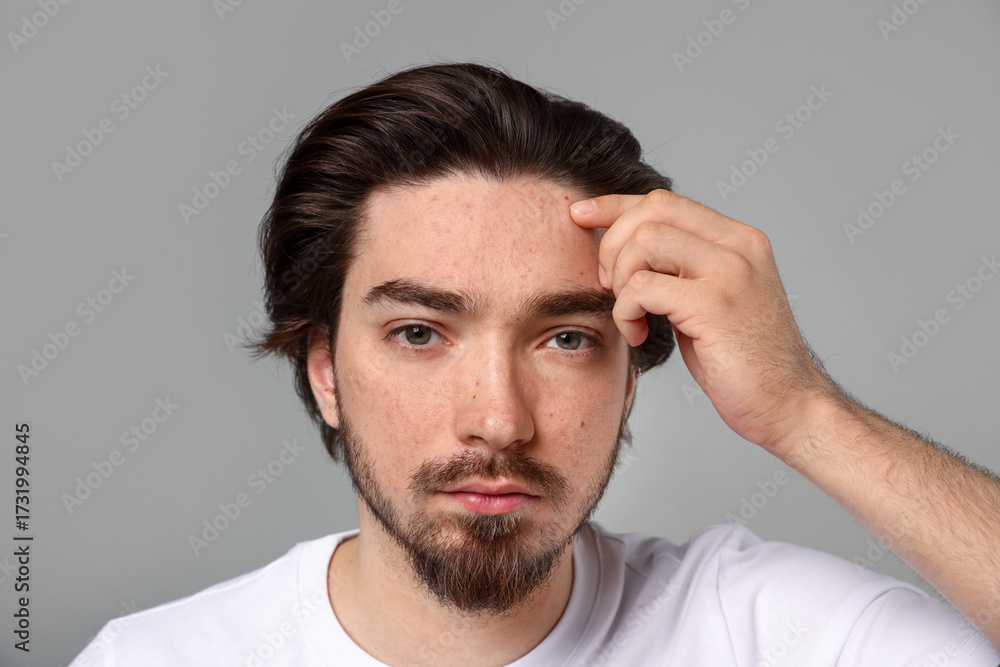 Fototapeta premium Young man with acne problem on light grey background