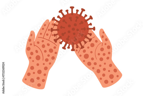 Hands with monkeypox rash holding a virus cell. New virus outbreak, pandemic concept. Contagious disease, skin infection symptom. Flat cartoon vector illustration for medicine.