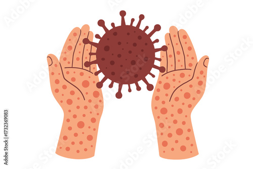 Monkeypox virus outbreak concept. Hands with skin rash holding a virus cell. Contagious disease, infection and pandemic vector illustration. Medical dermatology symbol.