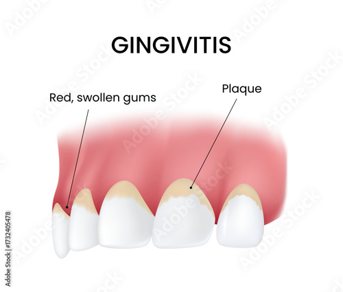 Gingivitis Red Swollen Gums and Plaque Buildup