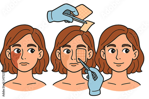 Artificial skin grafting process on girl's face for damaged skin restoration, transplantology medical procedure illustration, vector cartoon with transparent background