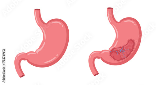 Healthy and Diseased Stomach Comparison Showing Gastric Ulceration and Inflammation