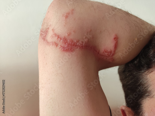 Chemical burn from a Rhopilema nomadica jellyfish on a man's arm