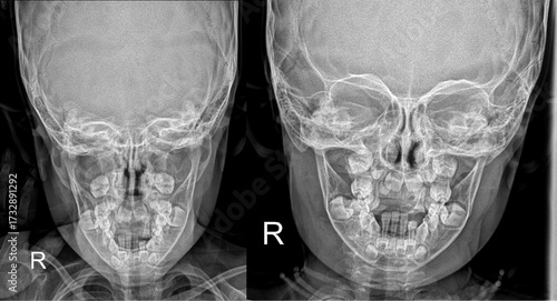 Pediatric mandible x ray PA