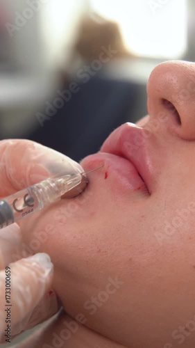 Beautician doctor makes botulinum toxin injection in the lips of young beautiful woman. Colorcorrected 4k vertical shot