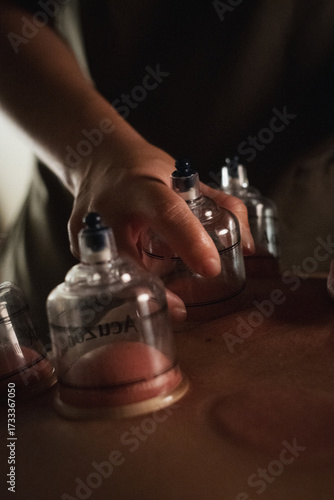 Close-up of a professional performing cupping therapy on a patient’s back in a wellness clinic. Alternative medicine treatment for muscle tension, relaxation, and detoxification.