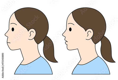 Φωτογραφία Comparison of female side profiles showing overbite and normal alignment, medica
