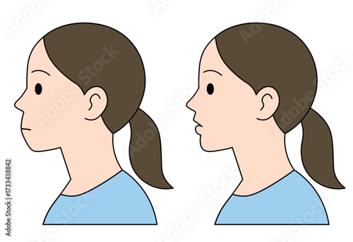 Comparison of female side profiles showing overbite and normal alignment, medical dental orthodontic illustration for healthcare and educational use