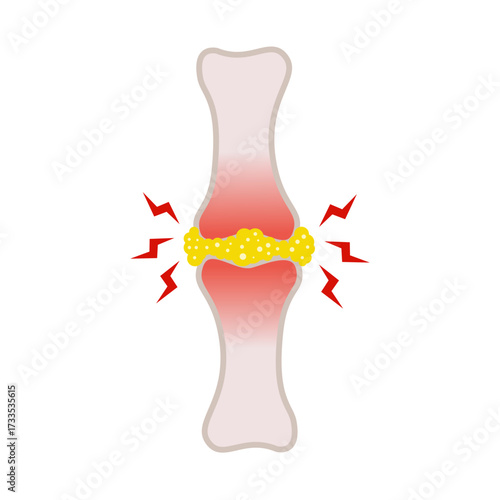 gout disease concept. vector illustration