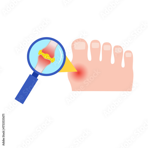gout disease concept. vector illustration