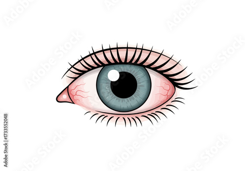 Illustration of an Inflamed Eye with Visible Blood Vessels.