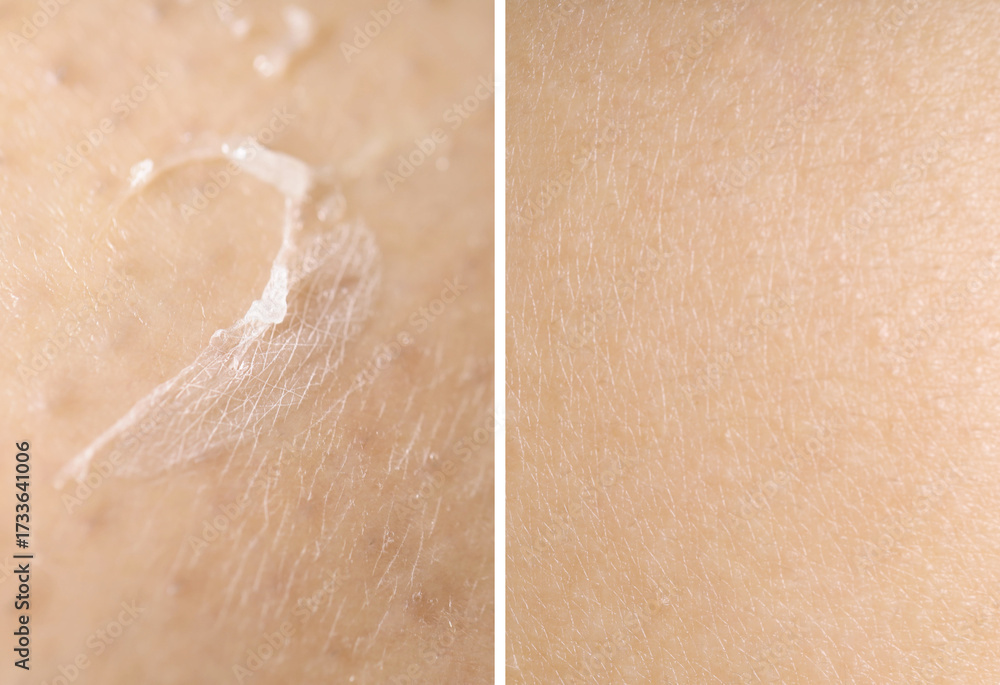 Fototapeta premium Dry skin on one side and moisturized on another, collage before and after