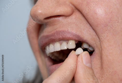 Loss of a dental implant. The woman has her mouth open and is holding the fallen dental crown with her fingers, showing the area where the implant broke off. Dental concept. 