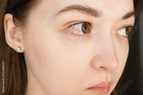 Vászonkép Close up of young woman with red inflamed eye with visible blood vessels