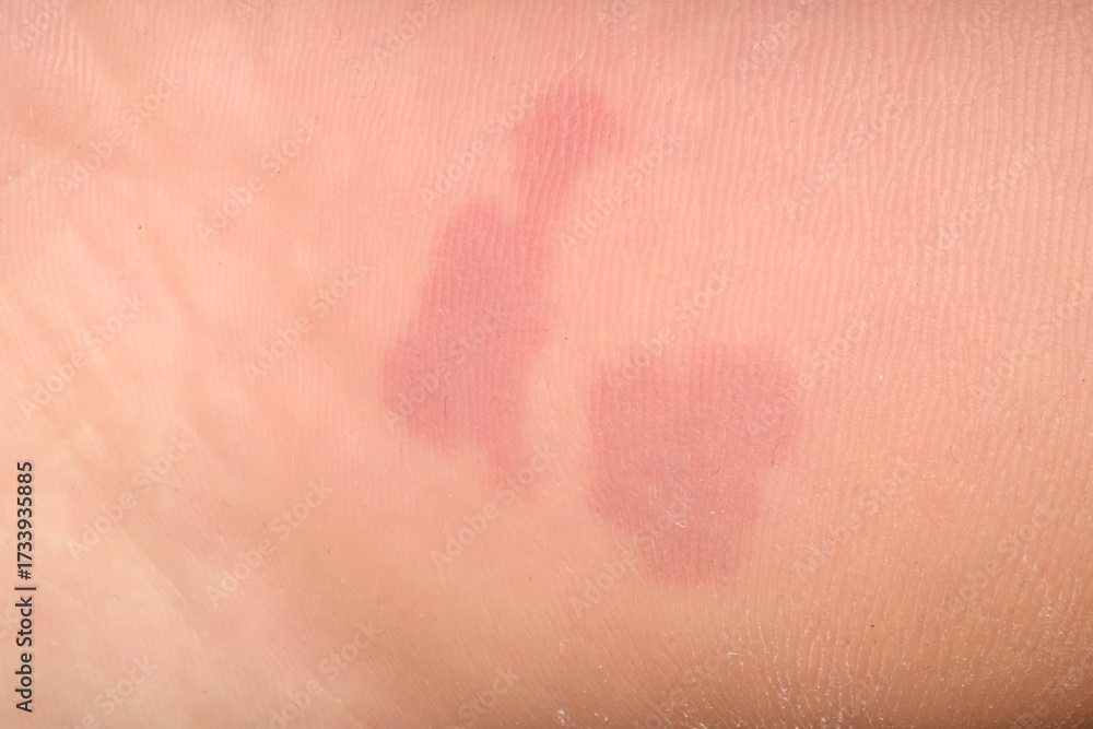 Fototapeta premium Macro view of dry human skin with red spots as background
