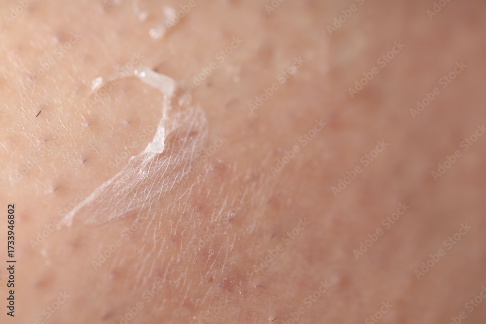 Fototapeta premium Closeup view of woman with dry skin