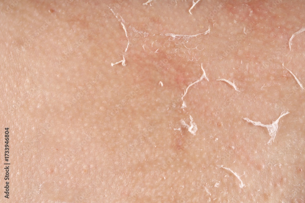Fototapeta premium Closeup view of woman with dry skin