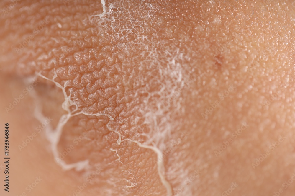 Fototapeta premium Woman with dry skin on her elbow, closeup