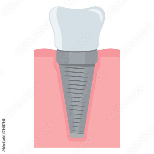 Dental implant. Screw prosthesis, Illustration of dental implantation,orthodontic dental implantation
