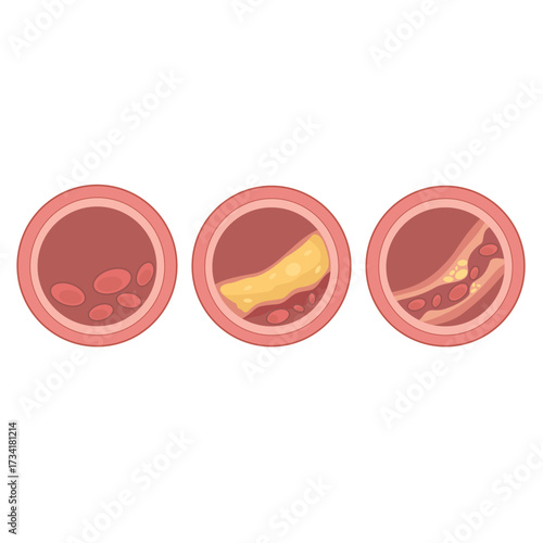 Detailed vector illustration of fat cells and cholesterol buildup inside a human blood vessel, designed for educational, medical, and anatomical learning or simulation purposes.