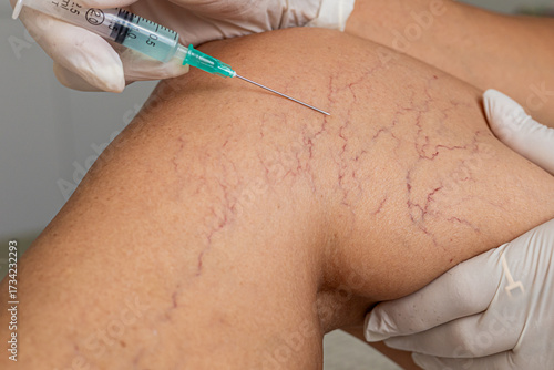 A close-up of a knee with visible varicose veins and capillaries. A gloved hand administers an injection into the skin, focusing on the treatment area.