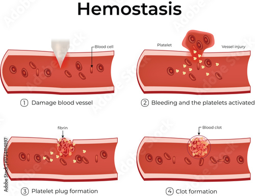 Hemostasis, Blood Vessel Injury, Platelet Plug Formation, and Coagulation Vector Illustration.