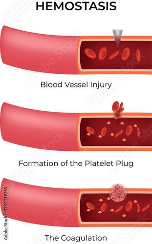 Hemostasis, Blood Vessel Injury, Platelet Plug Formation, and Coagulation Vector Illustration.