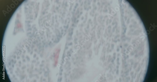 Close-up of Lung Cancer Cells Under Microscope
