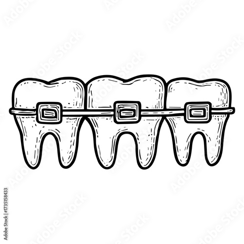 Braces