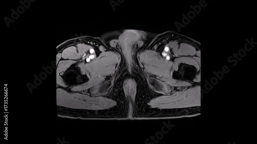 MRI Pelvis Cross Section Showing Central Structure and Surrounding Muscles