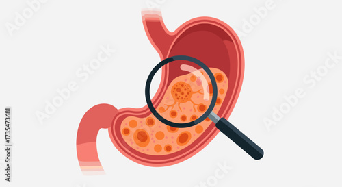 Magnifying glass examining a cancerous growth inside the stomach lining showing cellular details.