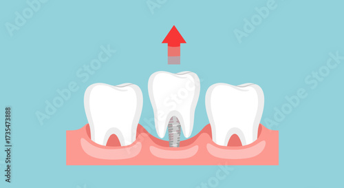 Understanding the tooth extraction and dental implant process for a healthier smile.
