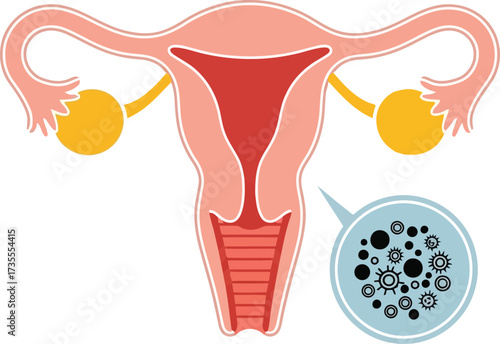 Anatomical illustration of female reproductive system with ovarian cysts detailed medical visual vector