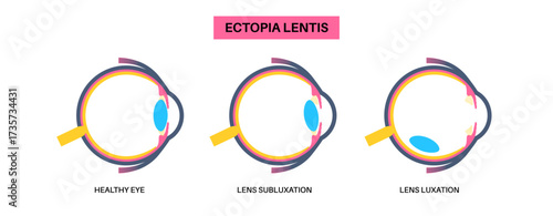Ectopia lentis disease