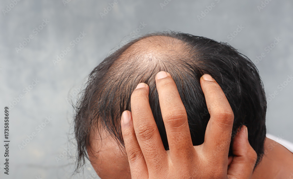 Fototapeta premium Asian Man with hair loss problems closeup,isolated. Alopecia balding hairs on man scalp. Human alopecia or hair loss-person hand pointing his bald head. Scratching his head. Baldness.Depression,stress