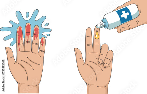 Cartoon first aid for burned fingers, vector illustration showing water cooling and antiseptic application for medical education and safety awareness content