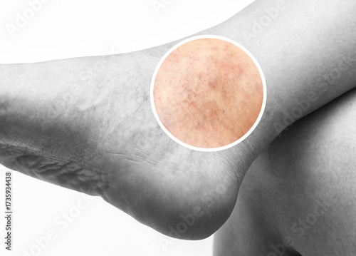 Konstfotografi Man shows  the dilation of small blood vessels of the skin on the leg