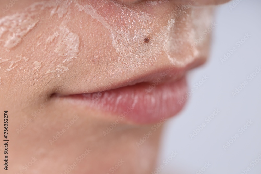 Fototapeta premium Woman with dry skin on her face against light background, closeup