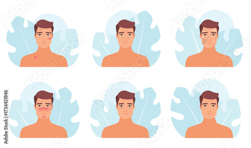 Male skin problem set vector illustration. Cartoon man with different types of medical troubles with skin collection, dark circle under eyes and wrinkles, acne and melasma, blackheads and rosacea