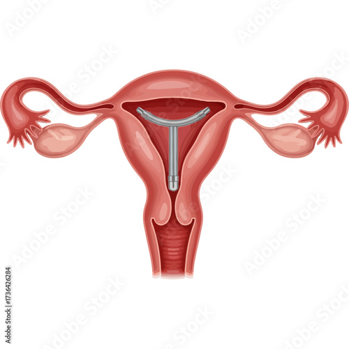 Medical illustration of intrauterine device (IUD) in female reproductive system