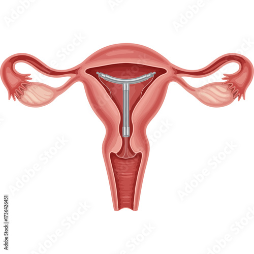 Medical illustration of intrauterine device (IUD) in human uterus
