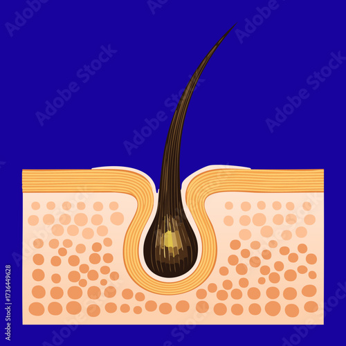 Detailed diagram of a single hair follicle with a clogged pore and excess sebum causing potential acne or infection