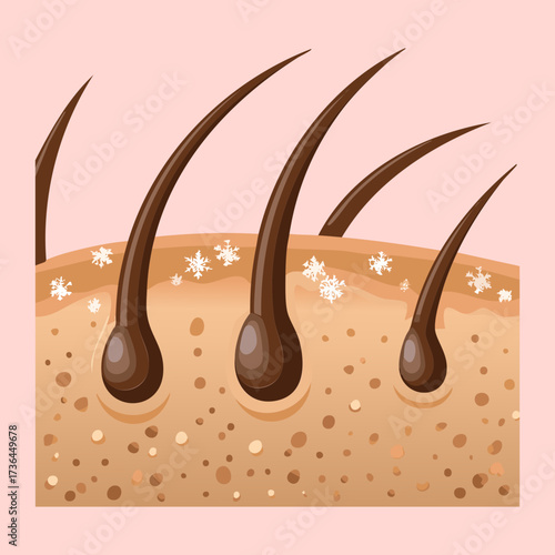 Detailed anatomical illustration of hair follicles and skin affected by dandruff flakes and unhealthy scalp conditions